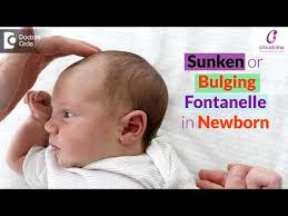 bulging sunken soft spots on baby s