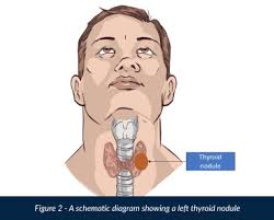 enlarged lymph nodes causes diagnosis