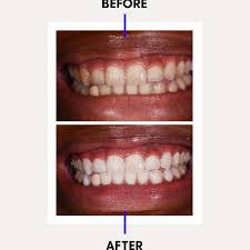 Make sure you gently brush all around your mouth, hitting each tooth, for the best results. What I Wish I D Known Before Trying Professional Teeth Whitening