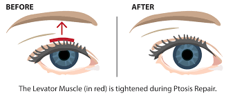 ptosis droopy eyelid repair vision