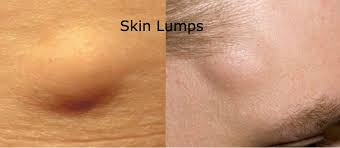 skin lump surgery singapore lipoma