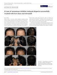 induced alopecia successfully treated