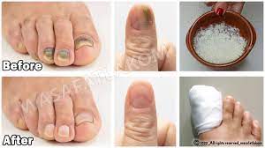 13 home remes for toenail fungus