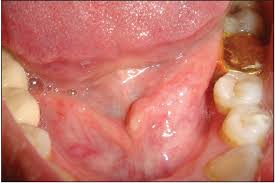 salivary gland infections
