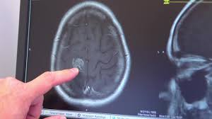 Image result for Gliomas brain tumors