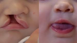cleft lip repair fisher subunit