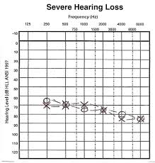 Vr4 Hearing Loss 6 Basic Hearing Evaluation