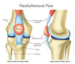 patellofem pain syndrome