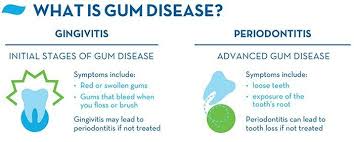 gum disease symptoms causes and