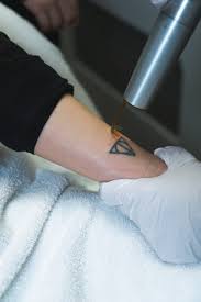 laser tattoo removal clinic in vancouver