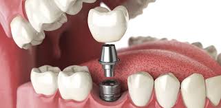 how much are dental implants golden
