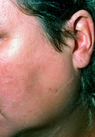parotid swelling due to blocked