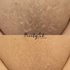 scar and stretch mark tattoo camouflage