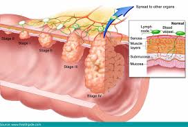 is esophageal cancer curable