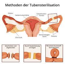 Eileiterdurchtrennung kosten