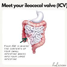 ileocecal valve pain
