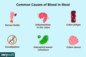 bright red blood in stool causes and