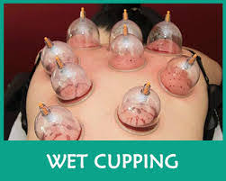 Chinese Cupping Welcome To Your Pain Is My Pain