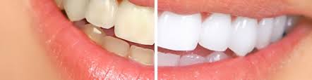 Best Teeth Whitening Benefits: How Your Smile Can Impact Your Life