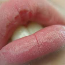 dry ed chapped lips