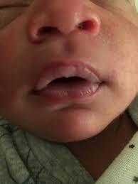 baby chapped blistered lips babycenter