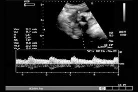 Fetal Heartbeat Week By Week Chart And Methods Used To