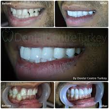 Hollywood Smile Makeover With Zirconium Crowns To Close The