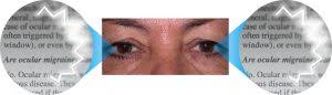 ocular migraines warwar eye group
