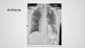 Check spelling or type a new query. How To Differentiate Between Low And High Quality Chest X Rays Medmastery