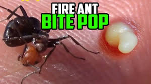 What helps ant bites heal faster? Question Why Do Fire Ant Bites Turn Into Pimples Black Lights