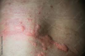 urticaria on skin rashes of which
