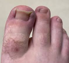 ingrown toenails foot ankle center