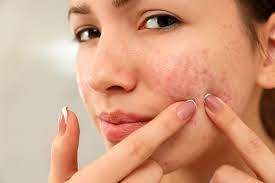 home remes to get rid of redness on face