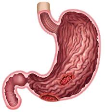 treatment for stomach ulcers in dallas