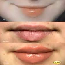 lip fillers augmentation procedure
