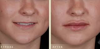 lip fillers the biggest non surgical