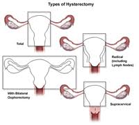 hysterectomies mon health cal center