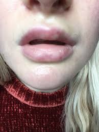 top lip following lip filler