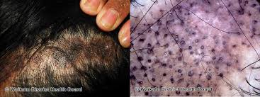 lupus and hair loss causes symptoms
