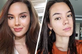 acne scars moles and all catriona