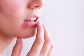herpes on tongue symptoms causes and