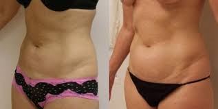 how much does laser liposuction cost