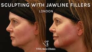 This gives you a tight jaw line and a fresh look. Sculpting With Jawline Fillers Viva Skin Clinics London