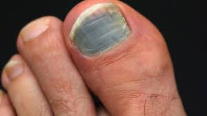 See more ideas about black toenail fungus, toenail fungus, toe nails. 3 Easy Ways To Treat A Black Toenail Wikihow
