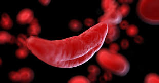 Gene therapy shows promise as potential cure for sickle cell disease