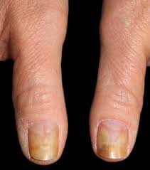 fungal nail infection diagnosis and