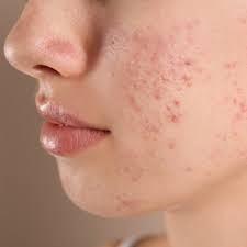 skincare may cause skin purging