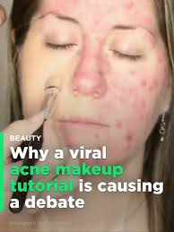 an acne makeup tutorial is going viral