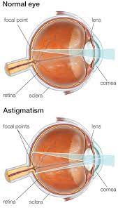 astigmatism correction specialists