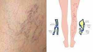 spider veins treatments what causes